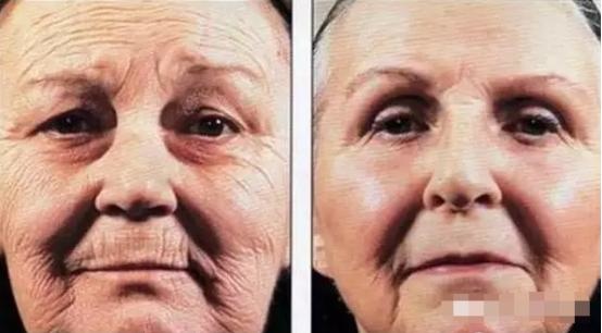 防曬紫外線SPF防曬乳挑選PA+++皮秒雷射755蜂巢皮秒雷射蜂巢透鏡picoSure新一代皮秒超皮秒雷射3.jpeg 防曬紫外線SPF防曬乳挑選PA+++皮秒雷射755蜂巢皮秒雷射蜂巢透鏡picoSure新一代皮秒超皮秒雷射3.jpeg