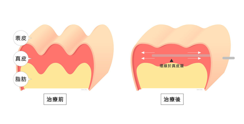 埋線拉皮費用埋線拉提失敗臉部埋線價格臉部埋線效果埋線拉提副作用埋線拉提推薦埋線拉皮術後埋線臉部價格4D埋線拉皮埋線拉皮推薦埋線種類林上立醫師推薦醫師液態拉皮上立提3.jpg