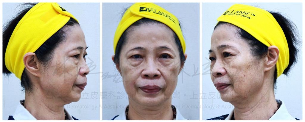 埋线拉提 铃铛线拉提 Nbsp 非手术性脸部拉提