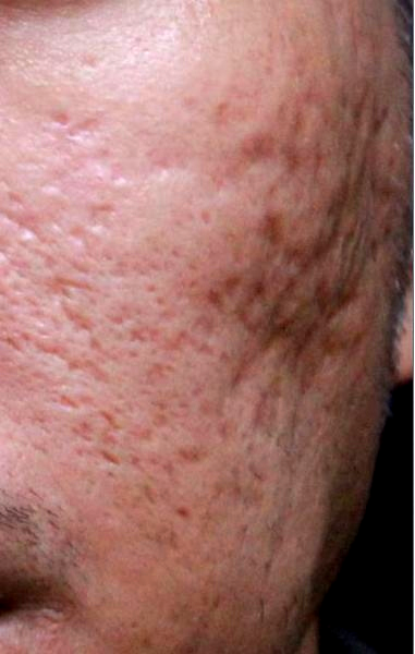 AcuPulse超脈衝雷射二氧化碳飛梭雷射痘疤凹疤縮毛孔PicoSure755皮秒雷射蜂巢透鏡755蜂巢皮秒雷射02.png AcuPulse超脈衝雷射二氧化碳飛梭雷射痘疤凹疤縮毛孔PicoSure755皮秒雷射蜂巢透鏡755蜂巢皮秒雷射02.png