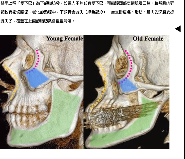 洢蓮絲ellanse聚己內酯PCL依戀詩易麗適少女針奇蹟針液態拉皮上立提二代童顏針膠原蛋白增生價格價位洢蓮絲雙下巴抽脂快速消除雙下巴消除雙下巴醫美雙下巴溶脂針臉打消脂針效果_2