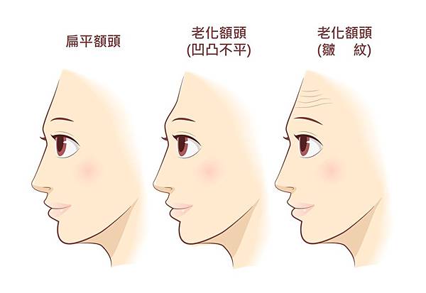 額頭凹陷老化皺紋細紋抬頭紋洢蓮絲肉毒桿菌755蜂巢皮秒雷射4