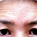 額頭凹陷老化皺紋細紋抬頭紋洢蓮絲肉毒桿菌755蜂巢皮秒雷射11