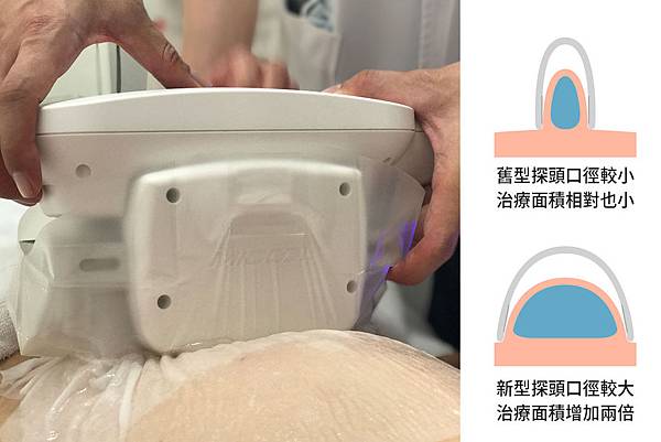 MICOOL-S冷凍溶脂效果冷凍溶脂價錢冷凍減脂心得冷凍溶脂推薦冷凍溶脂ptt冷凍溶脂原理冷凍溶脂術後瘦肚子的方法快速瘦肚子運動瘦肚子按摩快速瘦小腹運動瘦肚子飲食瘦肚子2