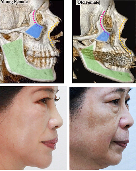 液態拉皮上立提舒顏萃洢蓮絲3D聚左旋乳酸童顏針sculptra依戀詩ellanse木偶紋改善木偶紋木偶紋肉毒桿菌醫美拉提嘴角下垂嘴邊肉8.png