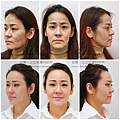 液態拉皮上立提膠原增生劑洢蓮絲舒顏萃童顏針少女針3D聚左旋乳酸sculptra依戀詩ellanse林上立醫師3.png