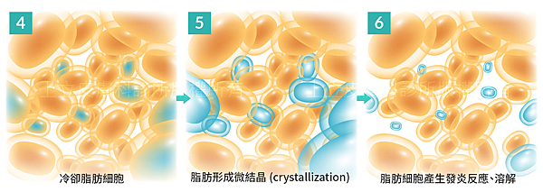 MICOOL-S冷凍溶脂效果冷凍溶脂價錢冷凍減脂心得冷凍溶脂推薦冷凍溶脂ptt冷凍溶脂原理冷凍溶脂術後瘦肚子的方法快速瘦肚子運動瘦肚子按摩快速瘦小腹運動瘦肚子飲食瘦肚子05.png