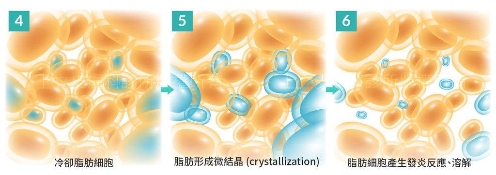 MICOOL-S冷凍溶脂效果冷凍溶脂價錢冷凍減脂心得冷凍溶脂推薦冷凍溶脂ptt冷凍溶脂原理冷凍溶脂術後瘦肚子的方法快速瘦肚子運動瘦肚子按摩快速瘦小腹運動瘦肚子飲食瘦肚子06.png