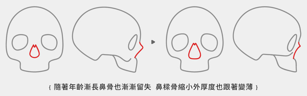 洢蓮絲隆鼻洢蓮絲ellanse聚己內酯PCL依戀詩易麗適少女針微晶瓷晶亮瓷隆鼻06.jpg