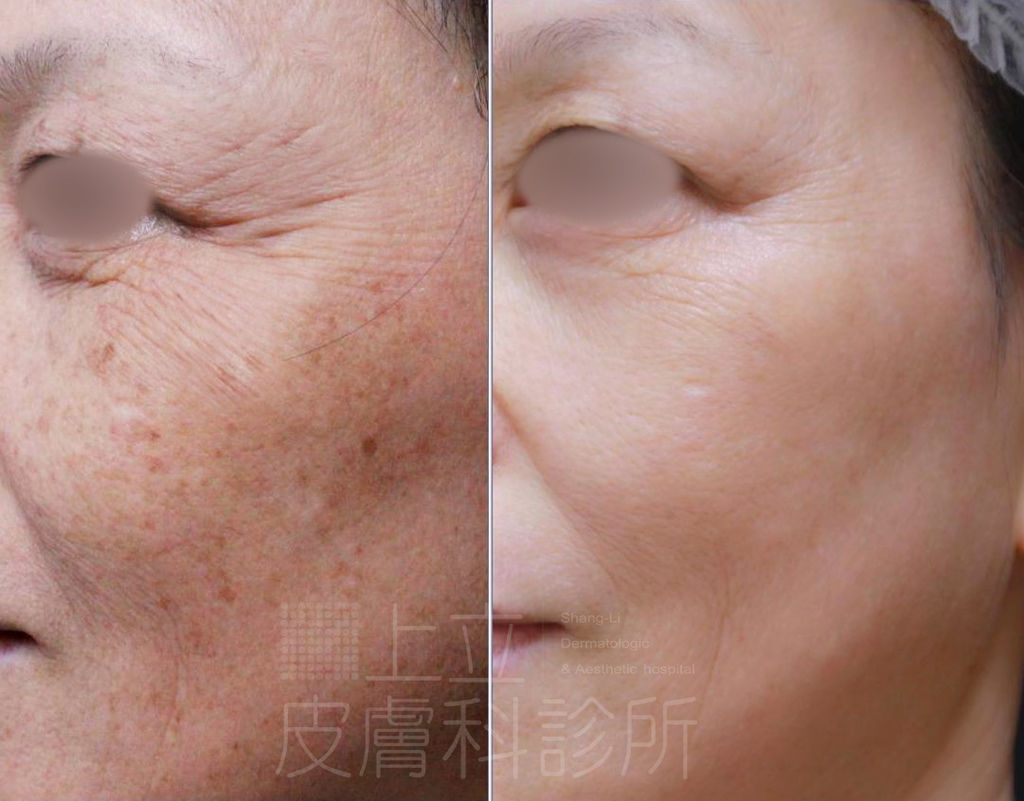 PicoSure755皮秒雷射蜂巢式聚焦陣列透鏡蜂巢透鏡皮秒雷射蜂巢皮秒雷射雀斑曬斑除斑痘疤毛孔細紋黑色素好膚質復原755蜂巢皮秒多久打一次蜂巢皮秒多少錢皮秒雷射價格755皮秒雷射價位06.jpg PicoSure755皮秒雷射蜂巢式聚焦陣列透鏡蜂巢透鏡皮秒雷射蜂巢皮秒雷射雀斑曬斑除斑痘疤毛孔細紋黑色素好膚質復原755蜂巢皮秒多久打一次蜂巢皮秒多少錢皮秒雷射價格755皮秒雷射價位06.jpg