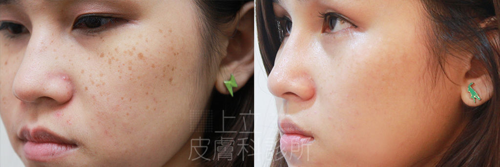 PicoSure755皮秒雷射蜂巢式聚焦陣列透鏡蜂巢透鏡皮秒雷射蜂巢皮秒雷射雀斑曬斑除斑痘疤毛孔細紋黑色素好膚質復原755蜂巢皮秒多久打一次蜂巢皮秒多少錢皮秒雷射價格755皮秒雷射價位03.jpg PicoSure755皮秒雷射蜂巢式聚焦陣列透鏡蜂巢透鏡皮秒雷射蜂巢皮秒雷射雀斑曬斑除斑痘疤毛孔細紋黑色素好膚質復原755蜂巢皮秒多久打一次蜂巢皮秒多少錢皮秒雷射價格755皮秒雷射價位03.jpg