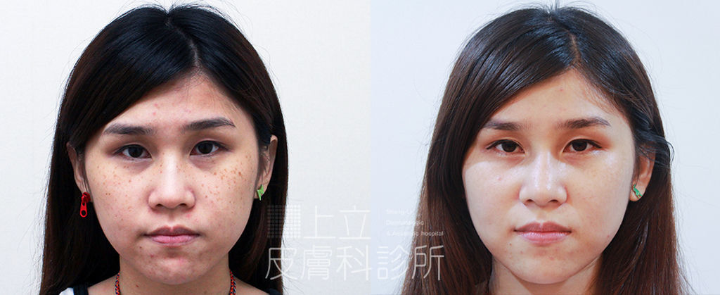 PicoSure755皮秒雷射蜂巢式聚焦陣列透鏡蜂巢透鏡皮秒雷射蜂巢皮秒雷射雀斑曬斑除斑痘疤毛孔細紋黑色素好膚質復原755蜂巢皮秒多久打一次蜂巢皮秒多少錢皮秒雷射價格755皮秒雷射價位02.jpg PicoSure755皮秒雷射蜂巢式聚焦陣列透鏡蜂巢透鏡皮秒雷射蜂巢皮秒雷射雀斑曬斑除斑痘疤毛孔細紋黑色素好膚質復原755蜂巢皮秒多久打一次蜂巢皮秒多少錢皮秒雷射價格755皮秒雷射價位02.jpg