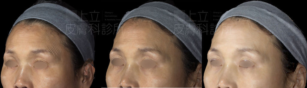 PicoSure755皮秒雷射蜂巢式聚焦陣列透鏡蜂巢透鏡皮秒雷射蜂巢皮秒雷射雀斑曬斑除斑痘疤毛孔細紋黑色素好膚質復原755蜂巢皮秒多久打一次蜂巢皮秒多少錢皮秒雷射價格755皮秒雷射價位07.jpg PicoSure755皮秒雷射蜂巢式聚焦陣列透鏡蜂巢透鏡皮秒雷射蜂巢皮秒雷射雀斑曬斑除斑痘疤毛孔細紋黑色素好膚質復原755蜂巢皮秒多久打一次蜂巢皮秒多少錢皮秒雷射價格755皮秒雷射價位07.jpg