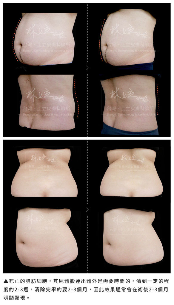 MICOOL-S冷凍溶脂效果冷凍溶脂價錢冷凍減脂心得冷凍溶脂推薦冷凍溶脂ptt冷凍溶脂原理冷凍溶脂術後瘦肚子的方法快速瘦肚子運動瘦肚子按摩快速瘦小腹運動瘦肚子飲食瘦肚子11.jpg