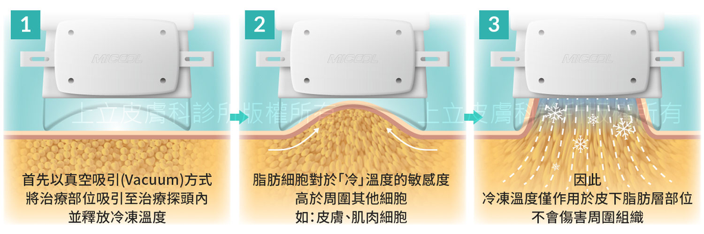 冷凍溶脂冷凍減脂MICOOL-S冷凍溶脂非侵入式體雕瘦身瘦肚子林上立醫生林上立醫師上立皮膚科診所瘦肚子冷凍減脂MICOOL-S台北哪裡做05.png