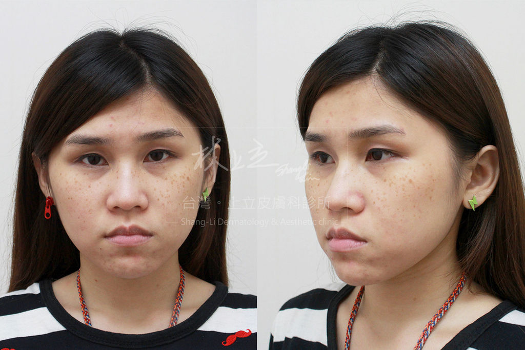 PicoSure755皮秒雷射蜂巢式聚焦陣列透鏡蜂巢透鏡皮秒雷射蜂巢皮秒雷射雀斑曬斑除斑痘疤毛孔細紋上立皮膚科診所林上立醫師5.jpg PicoSure755皮秒雷射蜂巢式聚焦陣列透鏡蜂巢透鏡皮秒雷射蜂巢皮秒雷射雀斑曬斑除斑痘疤毛孔細紋上立皮膚科診所林上立醫師5.jpg