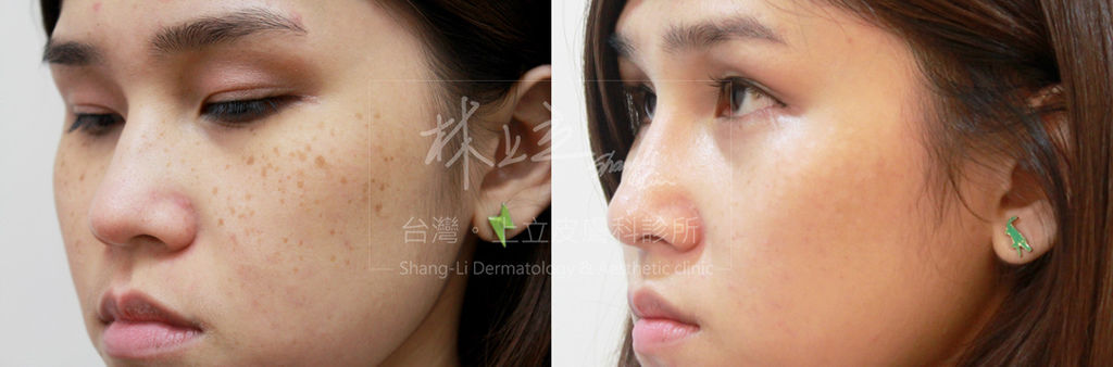 PicoSure755皮秒雷射蜂巢式聚焦陣列透鏡蜂巢透鏡皮秒雷射蜂巢皮秒雷射雀斑曬斑除斑痘疤毛孔細紋上立皮膚科診所林上立醫師8.jpg PicoSure755皮秒雷射蜂巢式聚焦陣列透鏡蜂巢透鏡皮秒雷射蜂巢皮秒雷射雀斑曬斑除斑痘疤毛孔細紋上立皮膚科診所林上立醫師8.jpg