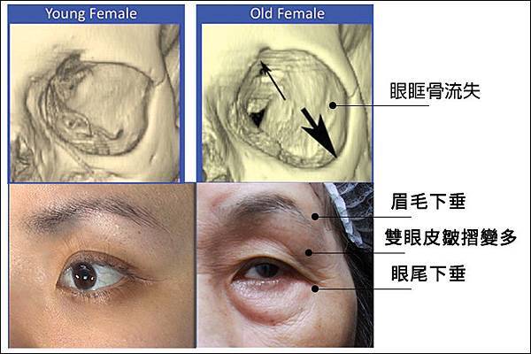洢蓮絲ellanse聚己內酯PCL依戀詩易麗適少女針奇蹟針液態拉皮上立提林上立醫師眉尾下垂眉毛下垂眉毛拉提眼尾下垂眼尾下垂改善4.jpg