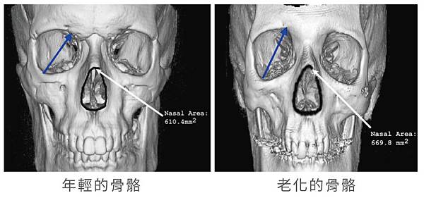 洢蓮絲ellanse聚己內酯PCL依戀詩易麗適少女針奇蹟針液態拉皮上立提林上立醫師眉尾下垂眉毛下垂眉毛拉提眼尾下垂眼尾下垂改善3.jpg