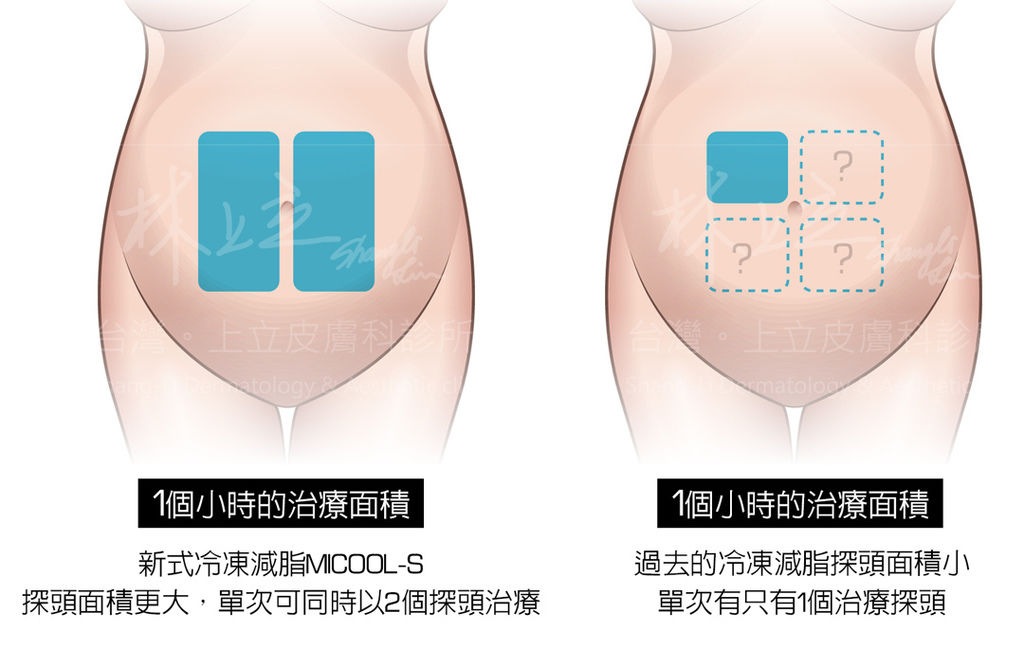 冷凍溶脂冷凍減脂MICOOL-S冷凍溶脂非侵入式體雕瘦身瘦肚子台北哪裡做冷凍溶脂MICOOL-S冷凍溶脂效果冷凍溶脂價錢冷凍減脂心得林上立醫生林上立醫師上立皮膚科診所 17.jpg