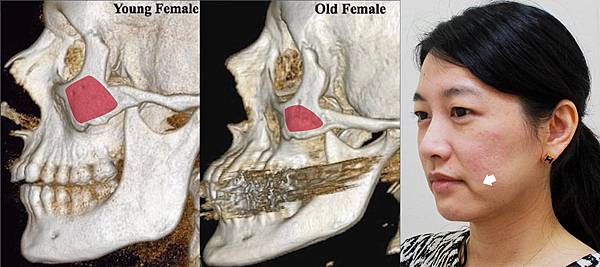 液態拉皮上立提二代童顏針膠原蛋白增生洢蓮絲費用價格術後保養1CC二代童顏針3D聚左旋乳酸手術拉皮4.jpg