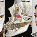 液態拉皮上立提二代童顏針膠原蛋白增生洢蓮絲費用價格術後保養1CC二代童顏針3D聚左旋乳酸手術拉皮4.jpg