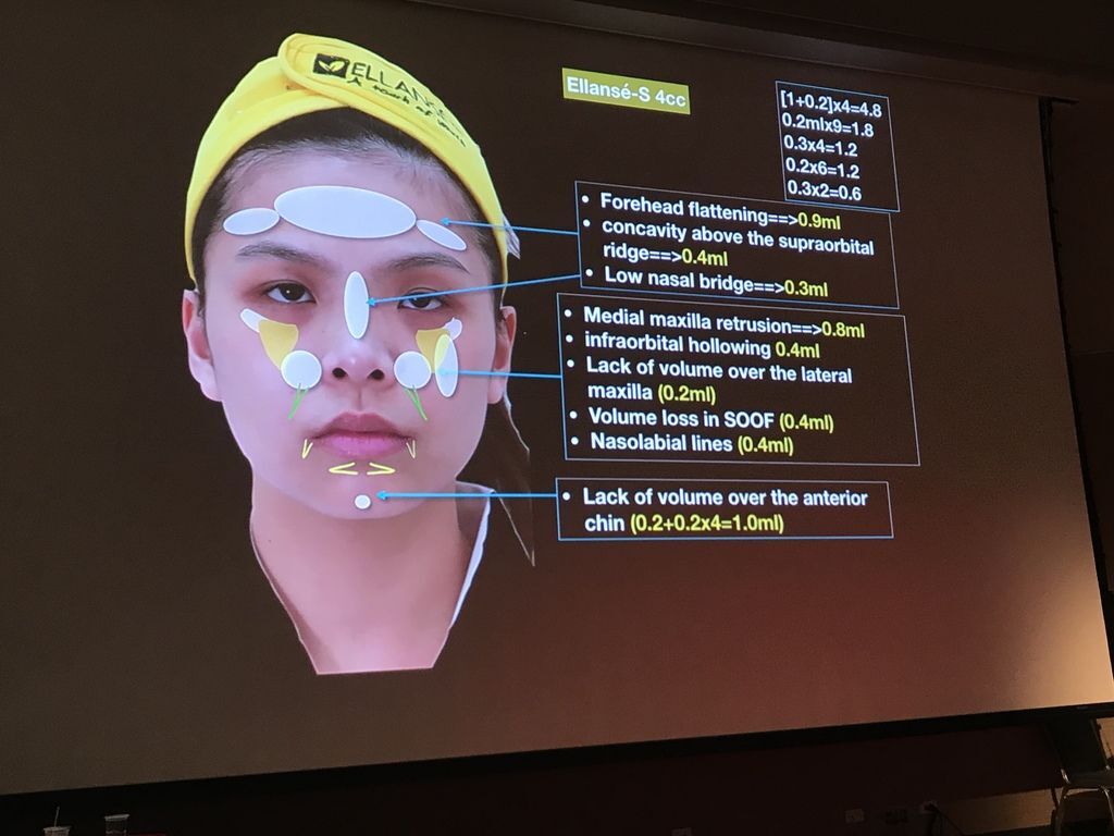 液態拉皮上立提舒顏萃sculptra3D聚左旋乳酸塑然雅童顏針淚溝洢蓮絲ellanse聚己內酯PCL依戀詩易麗適少女針奇蹟針液態拉皮上立提二代童顏07.jpg