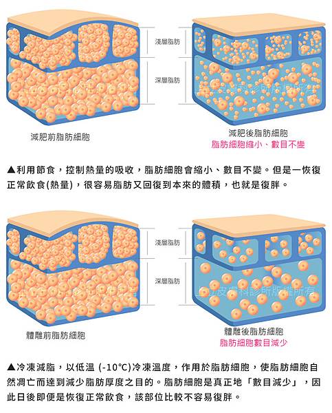 MICOOL-S冷凍溶脂副作用冷凍溶脂價錢冷凍減脂心得冷凍溶脂手臂冷凍溶脂推薦上立皮膚科診所林上立醫師07.jpg