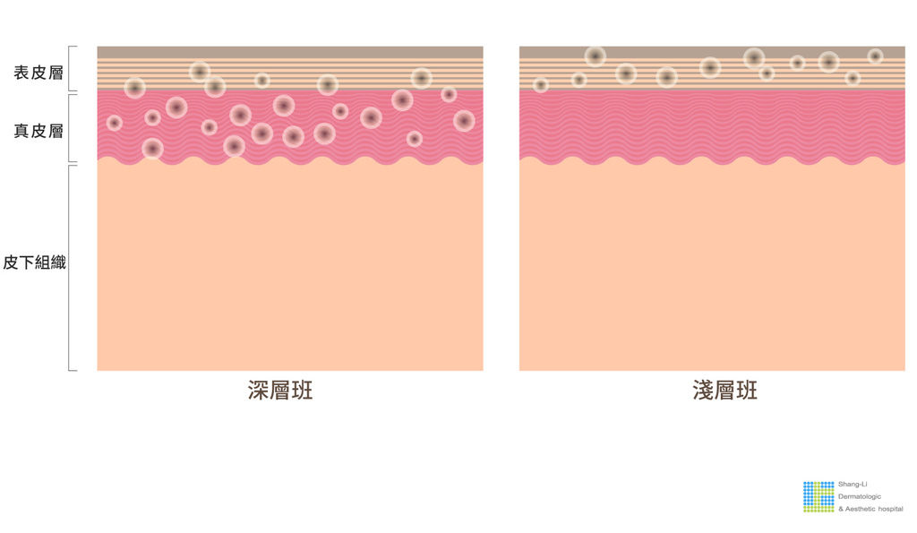 PicoSure755皮秒雷射蜂巢式聚焦陣列透鏡蜂巢透鏡皮秒雷射蜂巢皮秒雷射雀斑曬斑除斑痘疤毛孔細紋問答03.jpg PicoSure755皮秒雷射蜂巢式聚焦陣列透鏡蜂巢透鏡皮秒雷射蜂巢皮秒雷射雀斑曬斑除斑痘疤毛孔細紋問答03.jpg