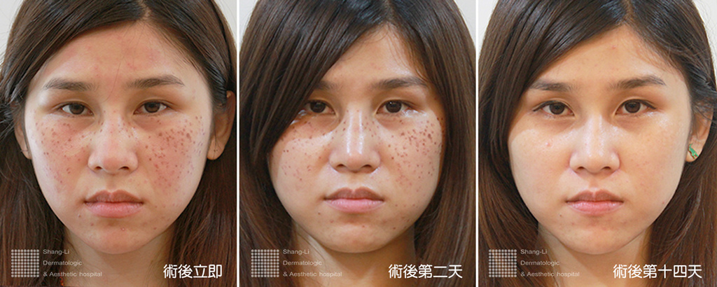 PicoSure755皮秒雷射蜂巢式聚焦陣列透鏡蜂巢透鏡皮秒雷射蜂巢皮秒雷射雀斑曬斑除斑痘疤毛孔細紋問答04.jpg PicoSure755皮秒雷射蜂巢式聚焦陣列透鏡蜂巢透鏡皮秒雷射蜂巢皮秒雷射雀斑曬斑除斑痘疤毛孔細紋問答04.jpg