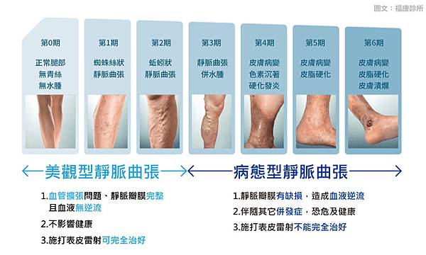 靜脈曲張雷射費用靜脈曲張雷脈術靜脈曲張創血管內雷射靜福診所雷射.jpg