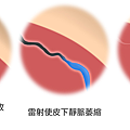 靜脈曲張雷射費用靜脈曲張雷射後遺症靜脈曲張雷射健保靜脈曲治療福康曲張治療推薦靜脈所台北張費用福診所雷射.png