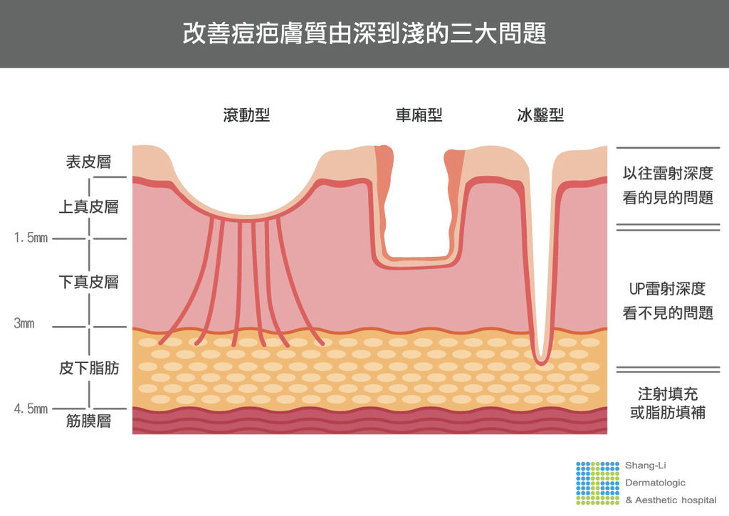 Up雷射ultrapulse汽化雷射雷射效果痘疤凹疤光老化治療副作用費用價錢up雷射永和皮膚科up雷射恢復期痘疤ppt林上立醫師上立皮膚科02.jpg