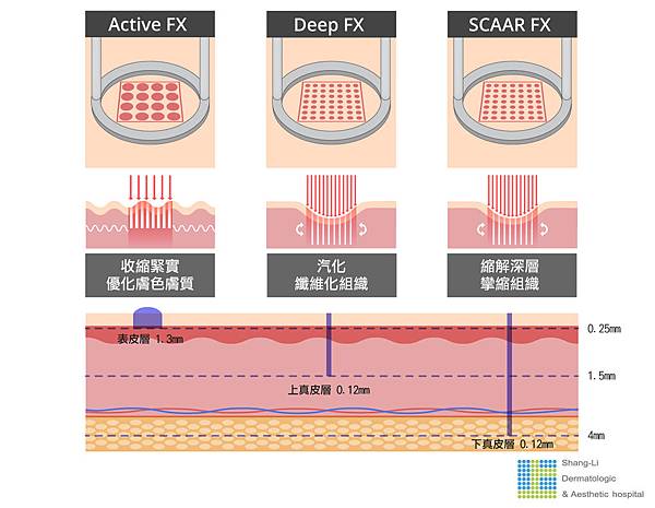 Up雷射ultrapulse汽化雷射雷射效果痘疤凹疤光老化治療副作用費用價錢up雷射永和皮膚科up雷射恢復期痘疤ppt林上立醫師上立皮膚科05.jpg