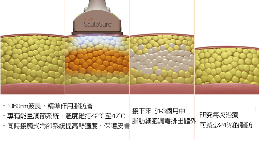 SculpSure體雕減肥減肥藥不好絲酷秀術後修復價格恢復期雷射體雕二極體冷凍溶脂減肥日記費用減肥食譜術後雷射溶脂局部平坦小腹塑身曲線雕塑林上立上立皮膚科診所05.jpg