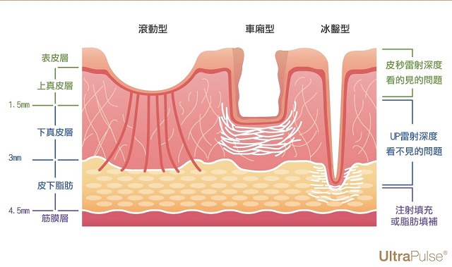 Up雷射ultrapulse汽化雷射雷射效果痘疤凹疤光老化痘疤治療副作用費用價錢痘疤保養效果凸疤深層痘疤up雷射永和皮膚科up雷射恢復期up雷射台北痘疤困擾術後保養up雷射要打幾次一次多少錢up雷射痘疤ppt林上立醫師上立皮膚科.jpg