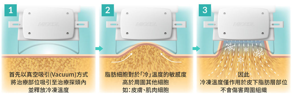 SculpSure體雕減肥減肥藥不好絲酷秀術後修復價格恢復期雷射體雕二極體冷凍溶脂減肥日記費用減肥食譜術後雷射溶脂局部平坦小腹塑身曲線雕塑林上立上立皮膚科診所 (2).jpg