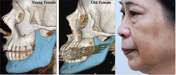 液態拉皮上立提立提少女線費用舒顏萃sculptra3D聚左旋乳酸洢蓮絲ellanse聚己內酯PicoSure755蜂巢皮秒雷射除斑痘疤毛孔細紋PCL台北醫美推薦抗老林上立醫師上立皮膚科診所11.jpg