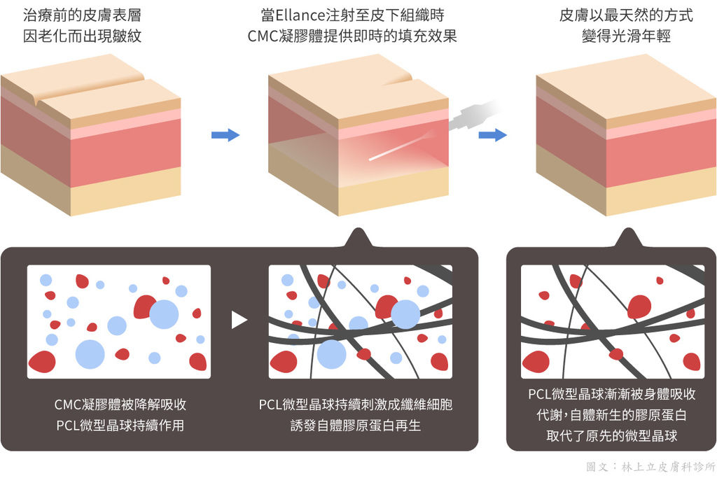 埋線立提少女線費用埋線拉提失敗臉部埋線價格臉部埋線效果埋線拉提副作用埋線立提少女線推薦立提少女線術後4D埋線拉皮埋線 (3).jpg