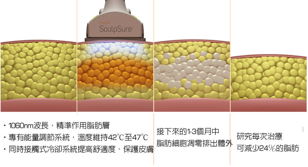 SculpSure體雕減肥好難燒肉非侵入式體雕吃減肥藥不好絲酷秀雷射體雕熱量有多少二極體冷凍溶脂雞排起司雞排鹹酥雞體脂肪 (5).jpg