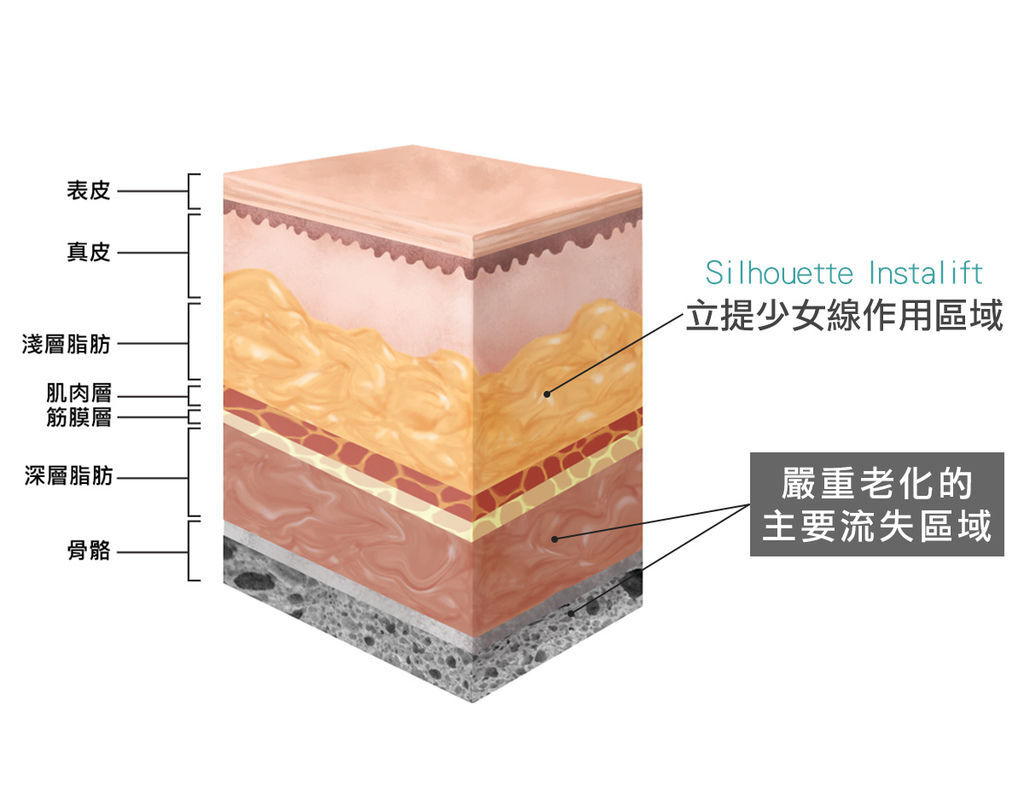 液態拉皮上立提舒顏萃sculptra3D聚左旋乳酸洢蓮絲ellanse聚己內酯PCL台北醫美推薦抗老林上立醫師上立皮膚科診所 (2).jpg