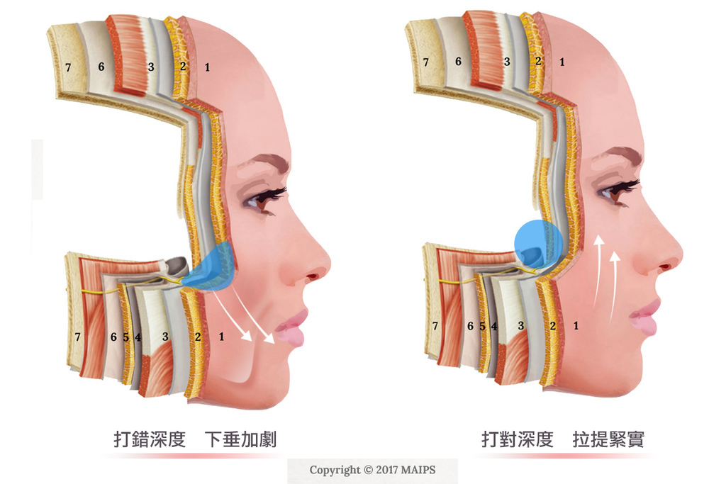 舒顏萃sculptra3D聚左旋乳酸塑然雅童顏針淚溝液態拉皮作用價格副作用效果淚溝按摩法令紋PLLA林上立上立皮膚科診所推薦醫師一瓶幾CC舒顏萃玻尿酸台北推薦 (2).jpg