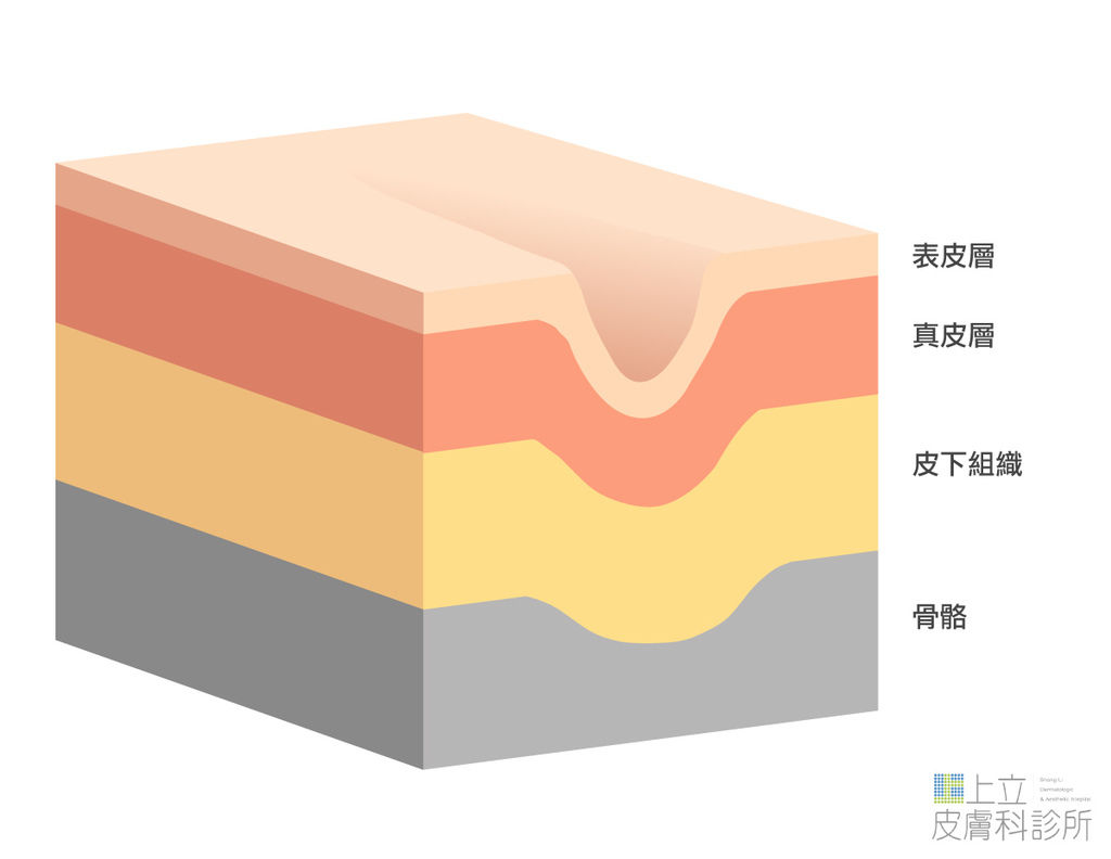 液態拉皮上立提舒顏萃sculptra3D聚左旋乳酸塑然雅童顏針淚溝洢蓮絲ellanse聚己內酯PCL依戀詩易麗適少女針奇蹟針液態拉皮上立提二代童顏針膠原蛋白增生洢蓮絲費用價格術後保養1CC價格價位洢蓮絲淚溝法令紋隆鼻下巴推薦醫師術後費用副作用液態拉皮二代童顏針聚左旋乳酸林上立醫師上立皮膚科診所台北推薦醫美醫師拉提雷射注射玻尿酸推薦