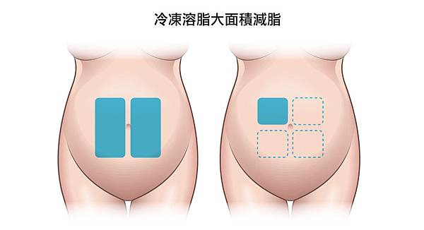 SculpSure體雕減肥減肥藥不好絲酷秀術後修復價格恢復期雷射體雕二極體冷凍溶脂減肥日記費用減肥食譜術後雷射溶脂局部平坦小腹塑身曲線雕塑林上立上立皮膚科診所03.jpg