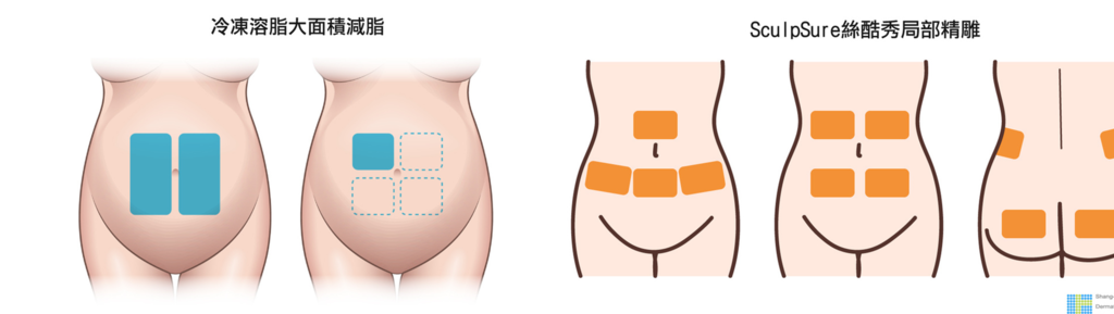 SculpSure體雕減肥減肥藥不好絲酷秀術後修復價格恢復期雷射體雕二極體冷凍溶脂減肥日記費用減肥食譜術後雷射溶脂局部平坦小腹塑身曲線雕塑林上立上立皮膚科診所03.png