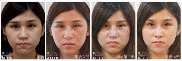 PicoSure755皮秒雷射蜂巢式雀斑曬斑除斑痘疤台北皮秒雷射推薦醫師皮膚科醫師痘疤凹疤飛梭雷射皮秒雷射價格副作用除斑凹洞淨膚雷射防曬推薦防曬乳曬黑紫外線04.jpg PicoSure755皮秒雷射蜂巢式雀斑曬斑除斑痘疤台北皮秒雷射推薦醫師皮膚科醫師痘疤凹疤飛梭雷射皮秒雷射價格副作用除斑凹洞淨膚雷射防曬推薦防曬乳曬黑紫外線04.jpg