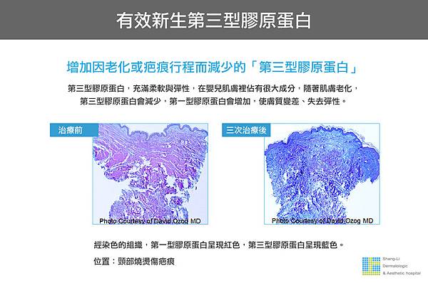 Up雷射ultrapulse汽化雷射雷射效果痘疤凹疤up雷射永和皮膚科林上立醫師上立皮膚科4.jpg