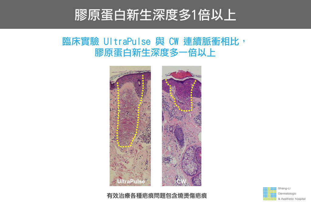 Up雷射ultrapulse汽化雷射雷射效果痘疤凹疤up雷射永和皮膚科林上立醫師上立皮膚科5.jpg Up雷射ultrapulse汽化雷射雷射效果痘疤凹疤up雷射永和皮膚科林上立醫師上立皮膚科5.jpg