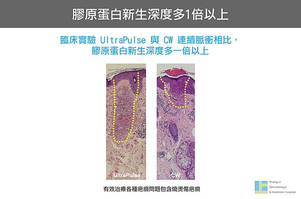 Up雷射ultrapulse汽化雷射雷射效果痘疤凹疤up雷射永和皮膚科林上立醫師上立皮膚科5.jpg