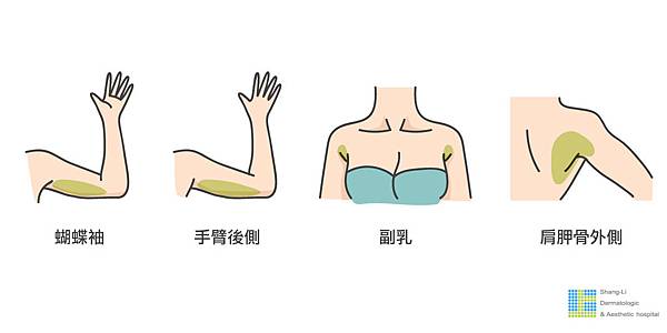 SculpSure體雕減肥絲酷秀術後修復價格恢復期雷射體雕二極體冷凍溶脂林上立上立皮膚科診所4.jpg